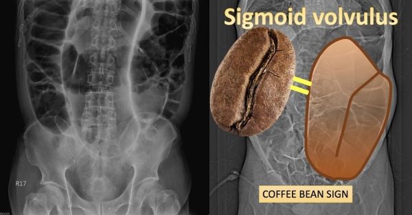 七旬老翁腹脹一週未排便　惡化腹痛就醫竟是大腸打結險喪命1